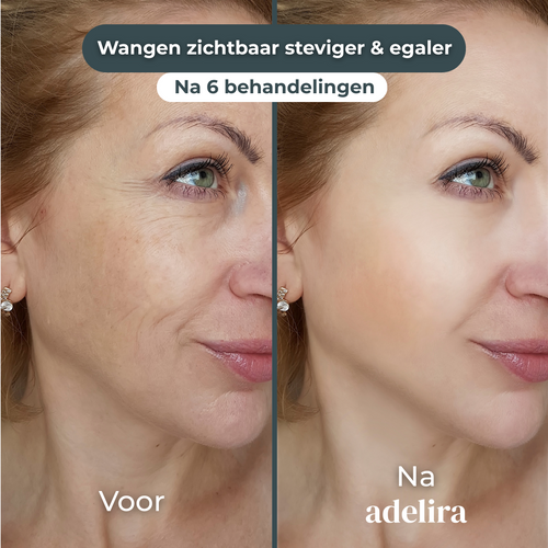 Wangen zichtbaar steviger & egaler