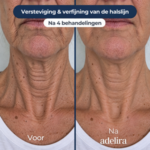 SkinFuse® Micro-Infusion System