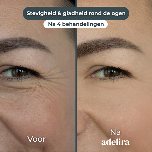 Gladheid & frisheid rond de ogen
