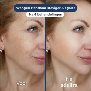 SkinFuse® Microneedling Systeem voor Thuisgebruik