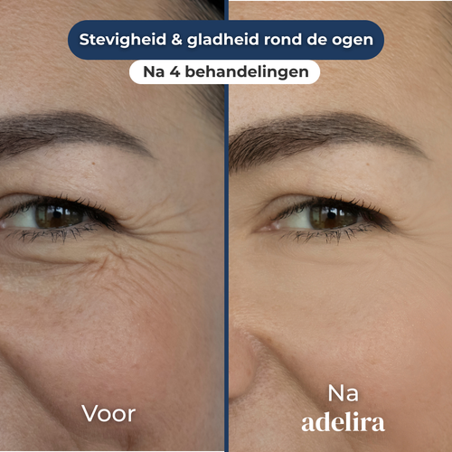 Gladheid & frisheid rond de ogen