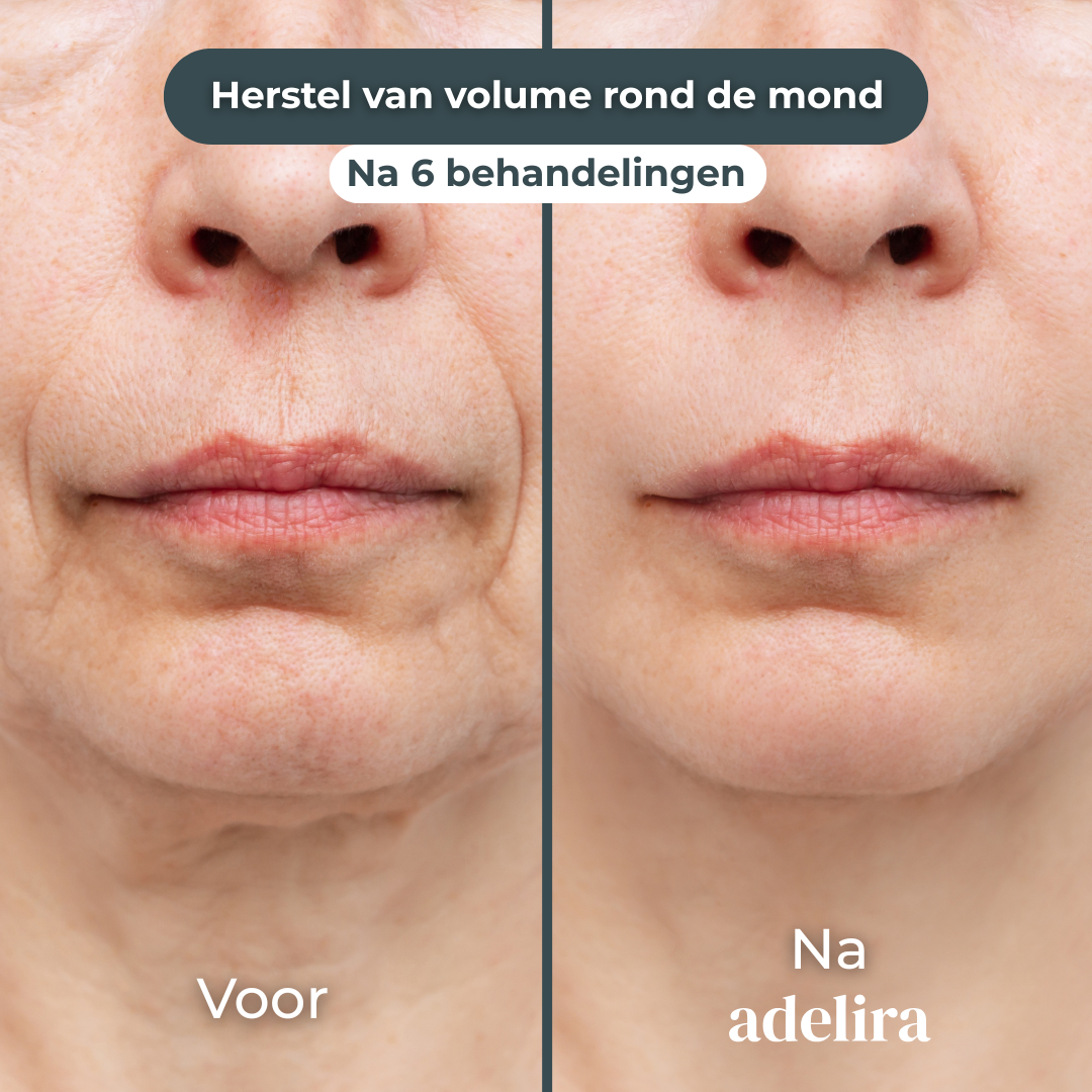 SkinFuse™ Micro-Infusion Kit 2.0