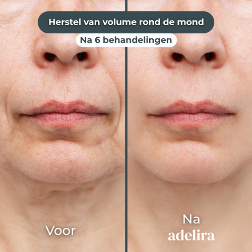 Zichtbaar vollere lipcontouren