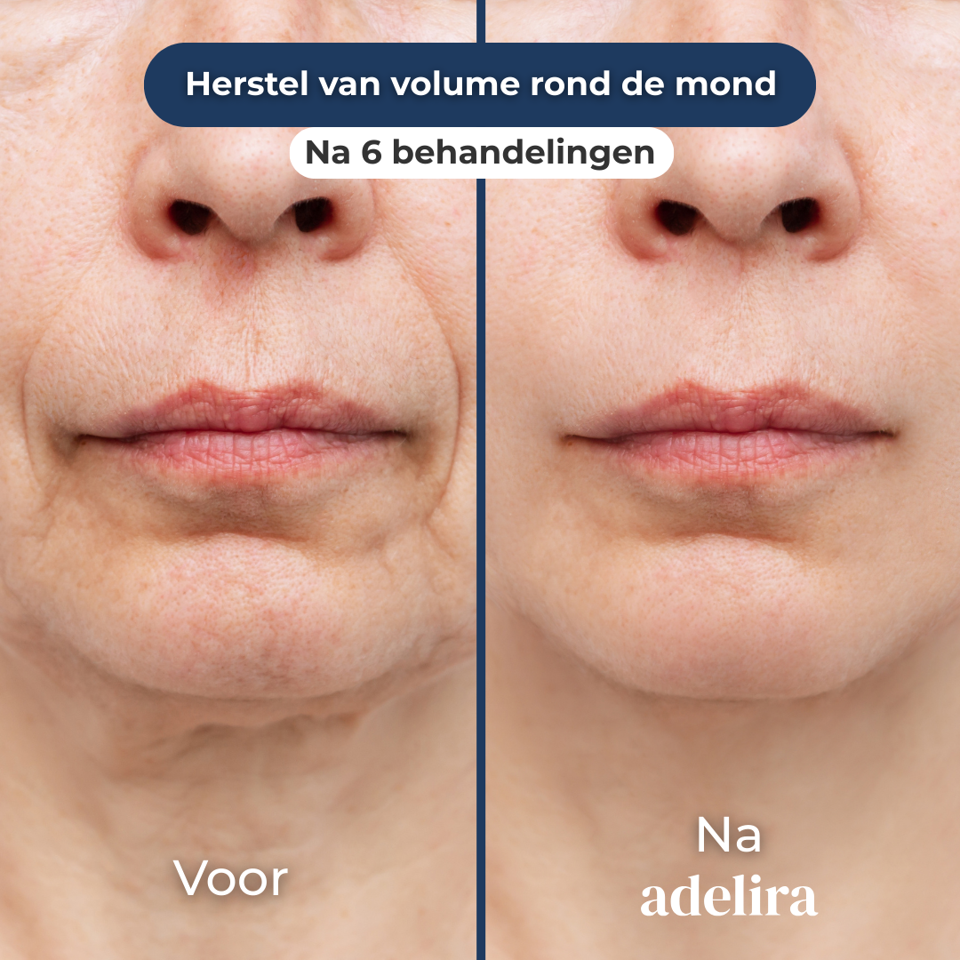 SkinFuse® Micro-Infusion System