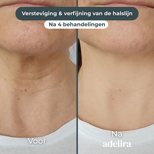 Strakkere en gladde halslijn