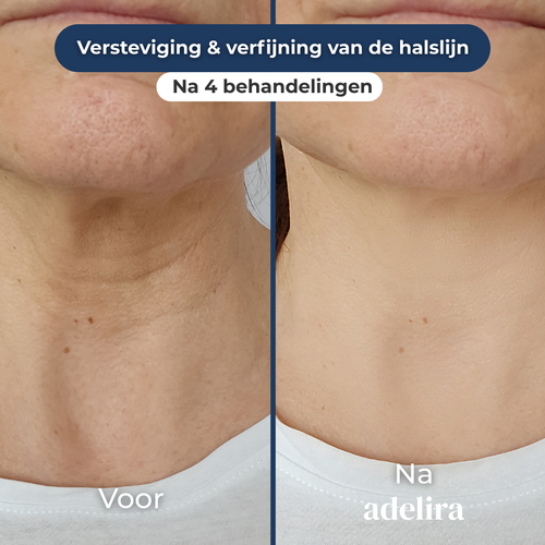 Strakkere en gladde halslijn