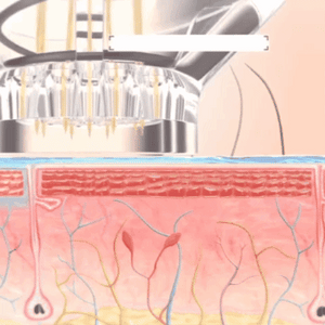 SkinFuse® Micro-Infusion System