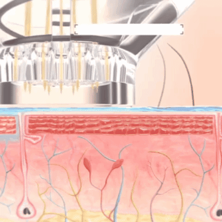 SkinFuse® Micro-Infusion System